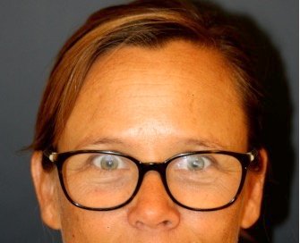 Browlift Foreheadplasty 102 - before - front