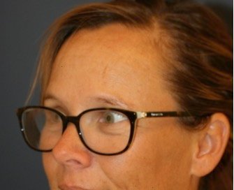 Browlift Foreheadplasty 102 - before - oblique