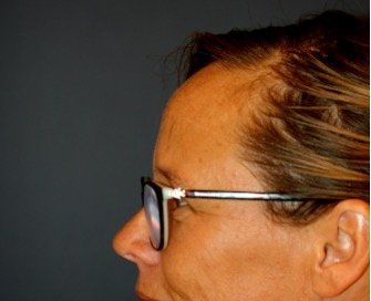 Browlift Foreheadplasty 102 - before - side