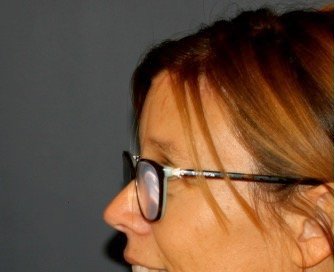 Browlift Foreheadplasty 102 - after - side
