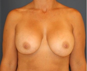 Breast Implant Removal 200 - before - front