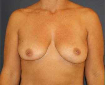 Breast Implant Removal 200 - after - front