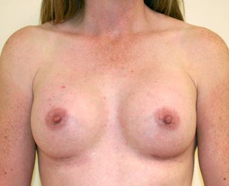 Breast Augmentation Case 40 - after - front