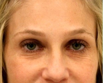 Blepharoplasty Upper/Lower Eyelids 106 - before - front