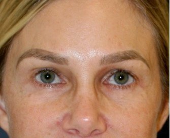 Blepharoplasty Upper/Lower Eyelids 106 - after - front
