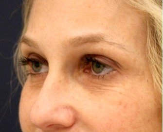 Blepharoplasty Upper/Lower Eyelids 106 - before - oblique