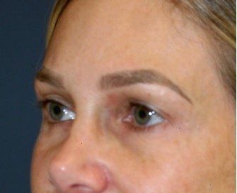 Blepharoplasty Upper/Lower Eyelids 106 - after - oblique