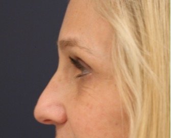 Blepharoplasty Upper/Lower Eyelids 106 - before - side