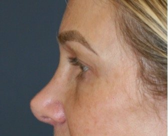 Blepharoplasty Upper/Lower Eyelids 106 - after - side