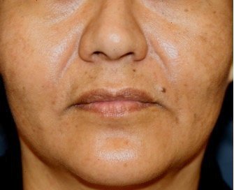 Corner Lip Lift 208 - before - front