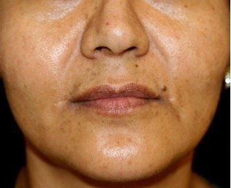 Corner Lip Lift 208 - after - front
