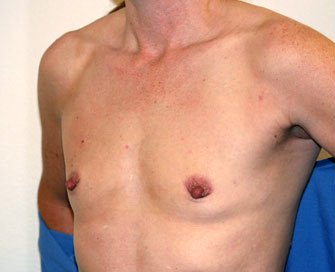 Breast Augmentation Case 40 - before - angle