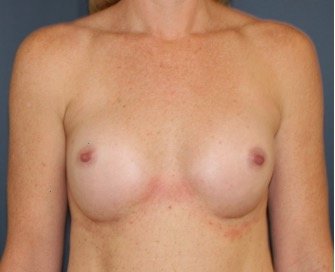 Natural Breast Augmentation 011 - after - front