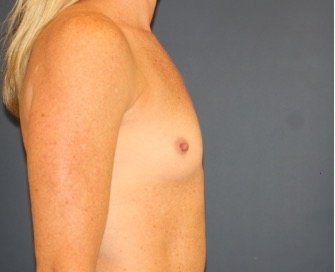 Natural Breast Augmentation 011 - before - side