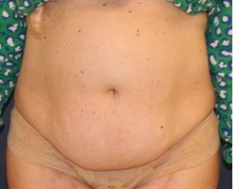 Tummy Tuck 223 - before - front