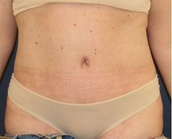 Tummy Tuck 223 - after - front