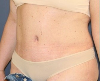 Tummy Tuck 223 - after - oblique