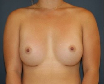Breast Augmentation 141 - after - front