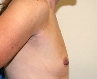 Breast Augmentation Case 40 - before - side