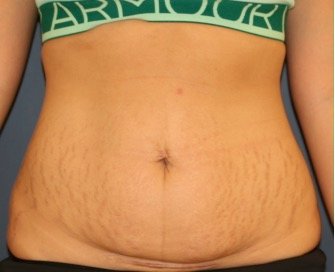 Tummy Tuck 224 - before - front