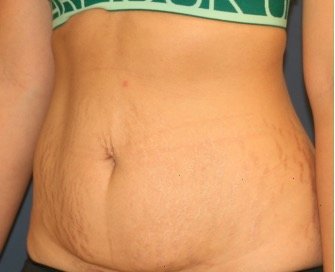Tummy Tuck 224 - before - oblique