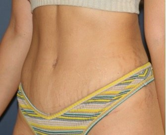 Tummy Tuck 224 - after - oblique