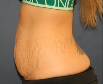 Tummy Tuck 224 - before - side