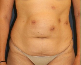 Tummy Tuck 225 - before - front