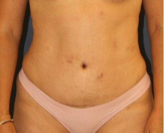 Tummy Tuck 225 - after - front