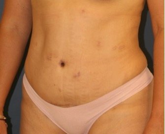 Tummy Tuck 225 - after - oblique