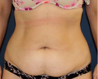 Tummy Tuck 226 - before - front