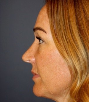 Rhinoplasty 206 - before - front