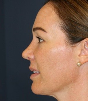 Rhinoplasty 206 - after - front