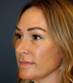 Rhinoplasty 206 - before - oblique