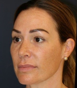 Rhinoplasty 206 - after - oblique