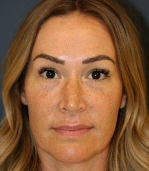 Rhinoplasty 206 - before - side