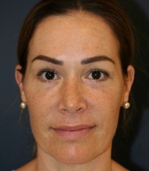 Rhinoplasty 206 - after - side