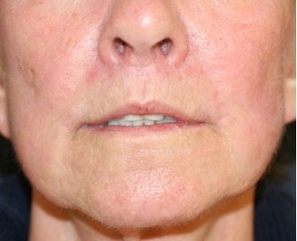 Liplift and Corner Liplift 209 - before - front