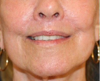 Liplift and Corner Liplift 209 - after - front
