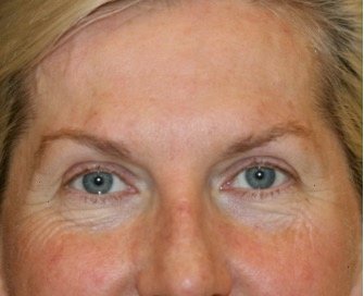 Browlift Case 103 - after - front