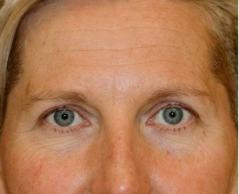 Blepharoplasty Upper Browlift 107 - before - front
