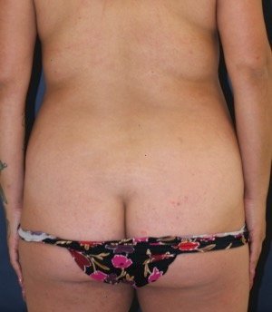 Liposuction Back-Waist 207 - before - front