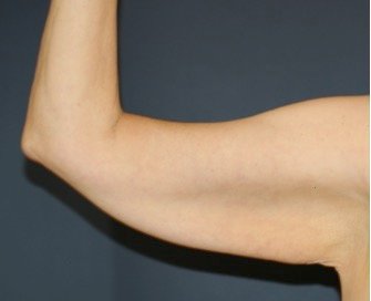 Arm Reduction 208 - before - front