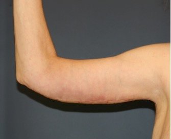 Arm Reduction 208 - after - front