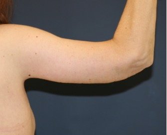 Arm Reduction 208 - after - oblique