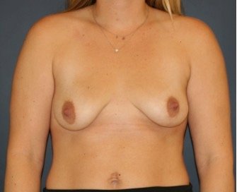 Breast Augmentation Lift 58 - before - front