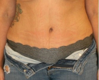 Tummy Tuck 228 - after - front