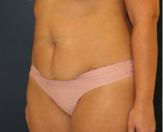 Tummy Tuck 228 - before - oblique