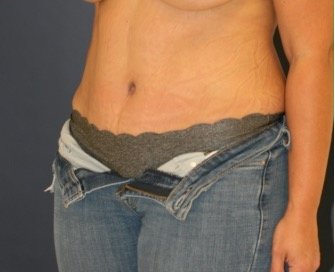 Tummy Tuck 228 - after - oblique