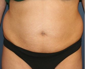 Tummy Tuck 229 - before - front